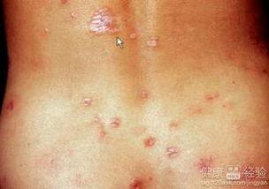 吃瓜梅毒,揭秘网络谣言背后的真相