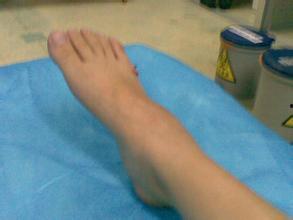 骨折手术后可以吃瓜,骨折手术后饮食指南